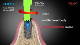 OSSTEM EFR KIT pt scoaterea implantului [upl. by Ainolopa]