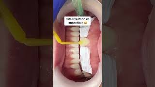 Mira el resultado de estos bordes incisales 👀 [upl. by Nnylhsa]