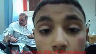 Chronic Progressive External Ophthalmoplegia  شلل عضلات العين [upl. by Eniawed]