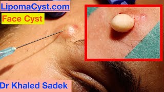 Massive Face Cyst Dr Khaled Sadek LipomaCystcom [upl. by Angelia]