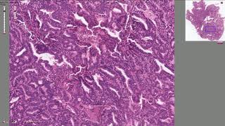 Endometrial Adenocarcinoma  Histopathology [upl. by Lengel]