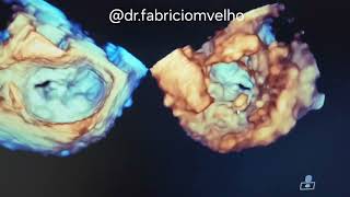 Necrose caseosa no anel mitral Componente móvel em face Ventricular [upl. by Torray605]