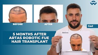 5 Months After ARTAS Robotic FUE Hair Transplant  We Grow Hair Indy [upl. by Leigh]