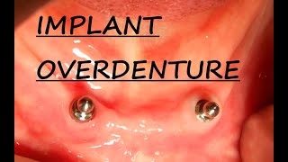 Implant Overdenture Planning  Part 1 Implant Supported Overdenture  Step by Step Planning [upl. by Sacci179]