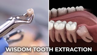 Wisdom Tooth Extraction  عقل داڈ نکالنا  The Complete Guide to Wisdom Tooth Extraction [upl. by Rorry]