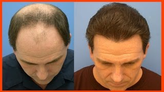 TRATAMENTO PARA CALVICE ➜ Como Um Careca Virou Cabeludo em 3 Meses [upl. by Chelsae]