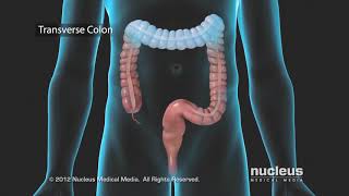 Colon Problems Diverticular Disease [upl. by Luiza]