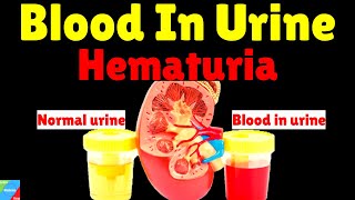 Blood In Urine Hematuria  Causes Symptoms Diagnosis Treatment amp Prevention [upl. by Ttehr]