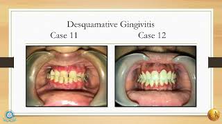 A diagnostic insight of common mucocutaneous lesions II MGMDCH [upl. by Enirehtac]