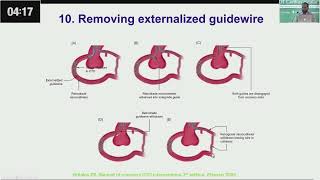 Retrograde CTO PCI Tips amp Tricks Wire Externalization by Dr Aftab khan [upl. by Girand612]