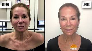 Kathie Lee Loves the Aerolase NeoSkin Rejuvenation Treatment [upl. by Dorrahs]