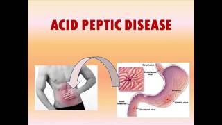 Acid Peptic Disease Presentation [upl. by Aliak]