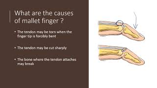 Mallet Finger Explained by Dr Alexander Anzarut [upl. by Gayelord537]