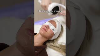 👀 What does a Lumecca IPL treatment look like [upl. by Naic]