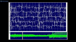 Kimura amp Kohara F20 Myotonic discharges mixed with spontaneous single muscle fiber discharges [upl. by Adahsar]