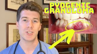 How to recognise and treat a Pyogenic Granuloma  Doctor ODonovan [upl. by Irec228]