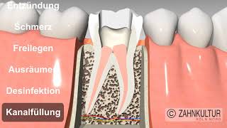 Wie läuft eine Wurzelkanalbehandlung ab  Wurzelbehandlung beim Zahnarzt [upl. by Akeem]