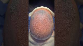 Norwood 7 transformation Hair transplant postop hairtransplant vincihairclinic shorts [upl. by Hortensa]