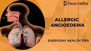 Allergic angioedemaSkin Allergy [upl. by Asemaj]