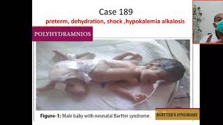 Case 189 hypokalemic metabolic alkalosis Bartter syndrome hyperprostaglandin Syndrome hypercalciu [upl. by Primaveria]