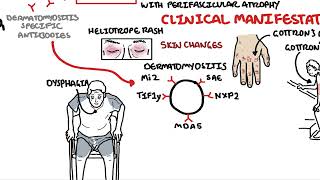 Dermatomyositis Overview [upl. by Ahseekal]