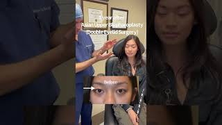 Double Eyelid Surgery by Dr Taban [upl. by Wittie]