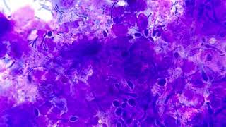 Oral candidiasis cytology [upl. by Nylrehs]