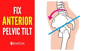 How to Fix Your Anterior Pelvic Tilt  STEPBYSTEP Guide [upl. by Siuraj]