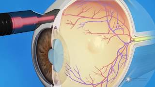 CPC for Glaucoma Treatment [upl. by Ettedanreb]