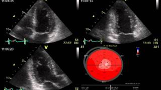 SPECKLE TRACKING ECHOCARDIOGRAPHY  HEART FUNCTION [upl. by Baiel456]