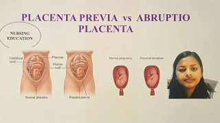 PLACENTA PREVIA VS ABRUPTIO PLACENTA FOR NCLEX EXAM AND NURSES USRN USNURSE [upl. by Chancellor]