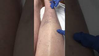 Sclerotherapy leg vein treatment with Asclera [upl. by Wendin]