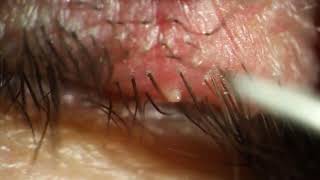 Pus from Eyelash Infection [upl. by Livvi]