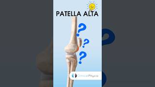 What is Patella Alta physiotherapy physicaltherapy patella [upl. by Bob]