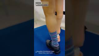 Prosthetics for Limb Length difference Anomalies orthoticsandprostheticslimblengthening [upl. by Shawna]