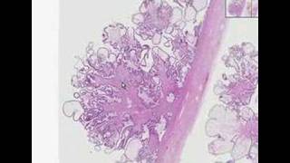 Histopathology OvarySerous cystadenoma [upl. by Decima997]