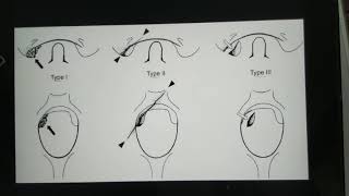 Occipital condyle fractures and Occipitocervical dissociation [upl. by Micky132]