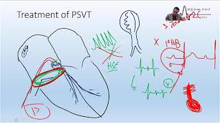 the Exact place of the slow AVN pathway and How we ablate AVNRT [upl. by Annayek]