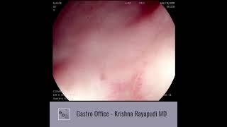 Gastric Ulcer video [upl. by Veronika]