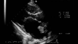 MS different aspectsmitral stenosis with LA thrombus [upl. by Seve]