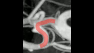 LIVE M1 MCA Aneurysm Flow Diverter [upl. by Adnara]