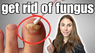 Get Rid Of Toenail Fungus With These 4 Easy Home Remedies [upl. by Alekehs646]