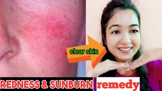 Skin Redness And Itching On Faceधूप में जानेसे skin में जलन और redness होतेहै तो Try This Face Pack [upl. by Blumenthal]