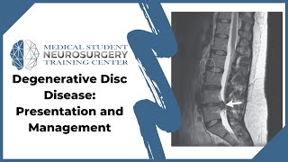 Degenerative Disc Disease Presentation and Management [upl. by Asserat765]