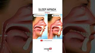 Sleep apnea surgery  Animated Video [upl. by Htebazie906]