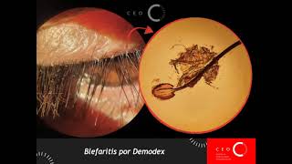 Multi CEO  Demodex [upl. by O'Malley]