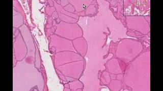 Histopathology ThyroidColloid goiter [upl. by Lapotin953]