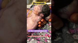 Cervical Myelomeningocele microcephaly vitaminb9 neuraltubedefects drsreedhargandikota [upl. by Itch]