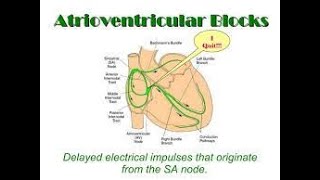 Atrioventricular Block  AV blocks made easy  AV block ECG interpretation  Types of AV Block [upl. by Fortin]