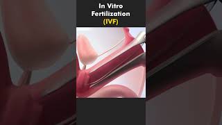 IVF Explained in 5 Minutes  The Science of BabyMaking [upl. by Thea379]